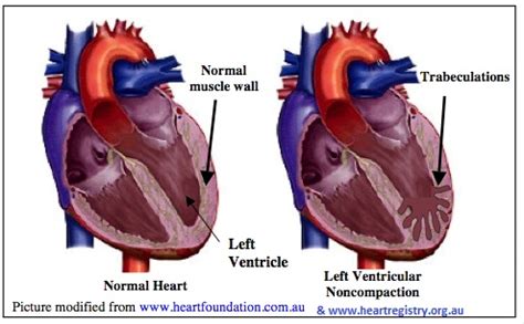 what is lv noncompaction